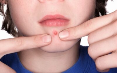 ESTOS HÁBITOS PODRÍAN ESTAR EMPEORANDO TU ACNÉ